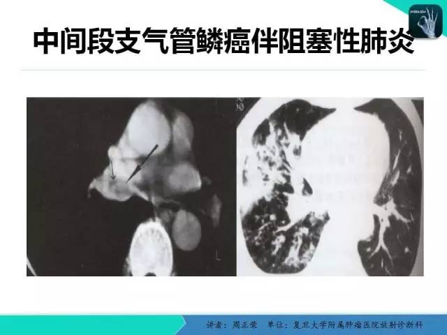 【PPT】肺癌的CT诊断