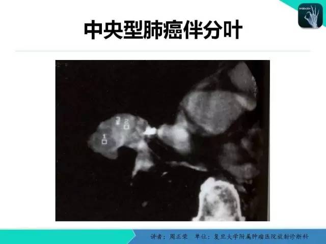 【PPT】肺癌的CT诊断