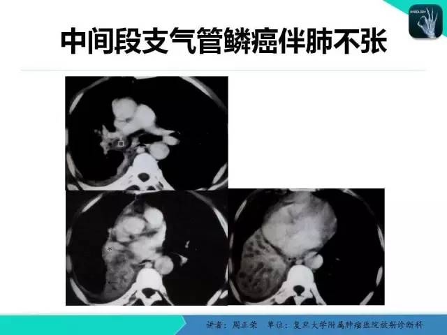 【PPT】肺癌的CT诊断