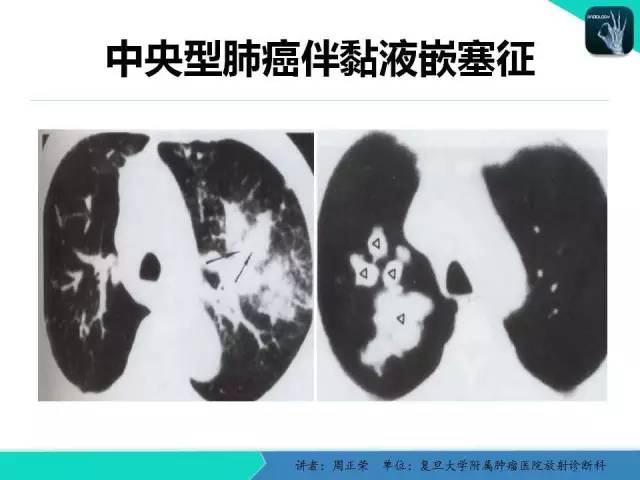 【PPT】肺癌的CT诊断