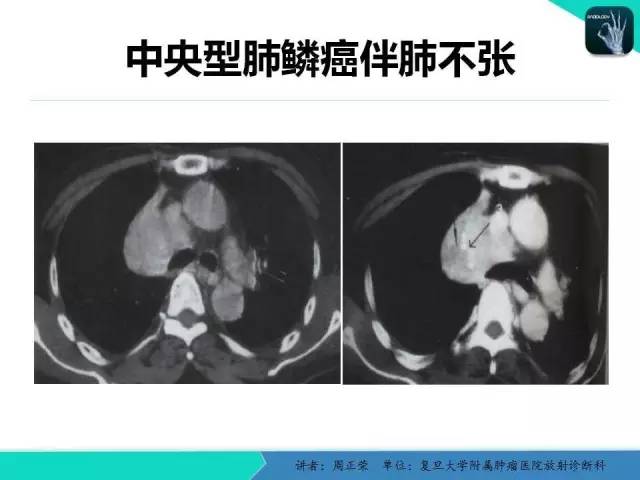 【PPT】肺癌的CT诊断