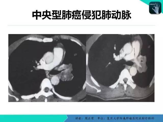 【PPT】肺癌的CT诊断