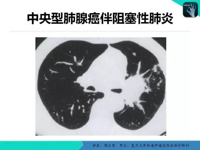 【PPT】肺癌的CT诊断