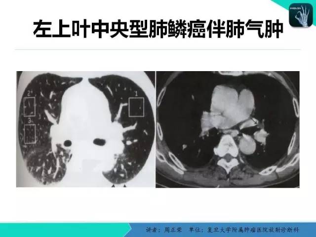 【PPT】肺癌的CT诊断