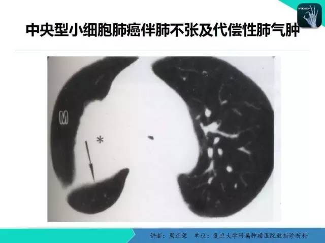 【PPT】肺癌的CT诊断