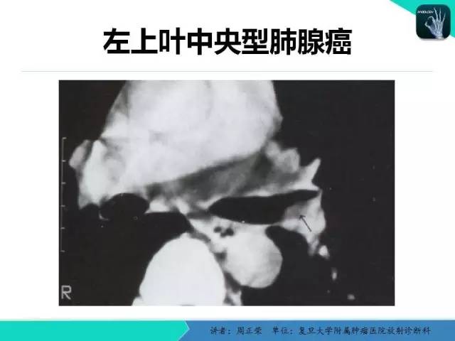 【PPT】肺癌的CT诊断