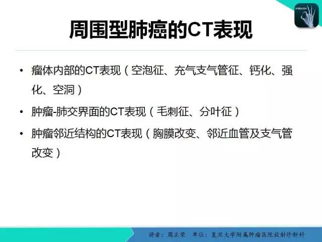 【PPT】肺癌的CT诊断