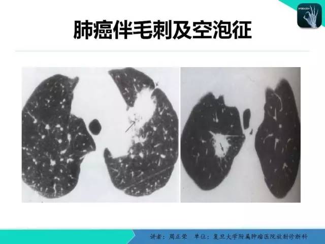 【PPT】肺癌的CT诊断