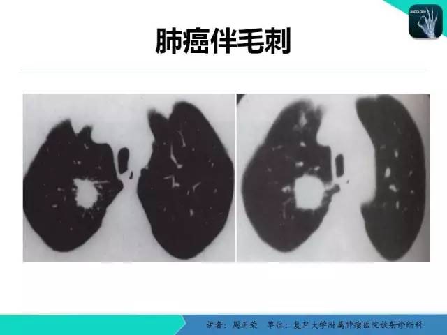 【PPT】肺癌的CT诊断