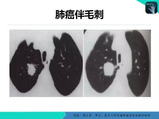 【PPT】肺癌的CT诊断