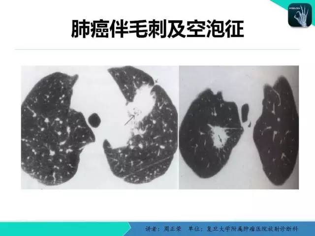 【PPT】肺癌的CT诊断