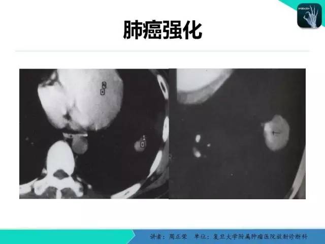 【PPT】肺癌的CT诊断
