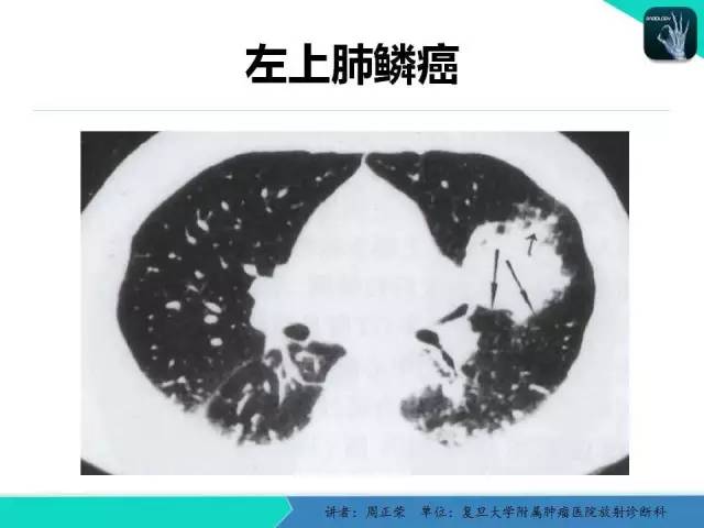 【PPT】肺癌的CT诊断