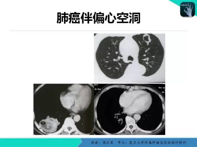 【PPT】肺癌的CT诊断