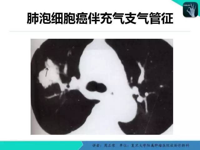 【PPT】肺癌的CT诊断