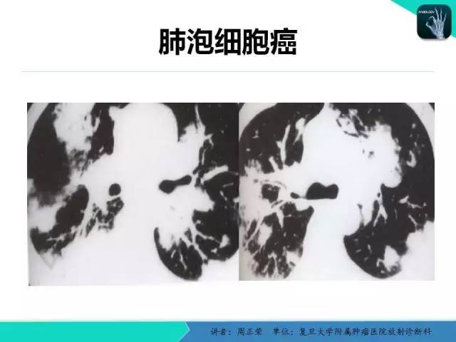 【PPT】肺癌的CT诊断