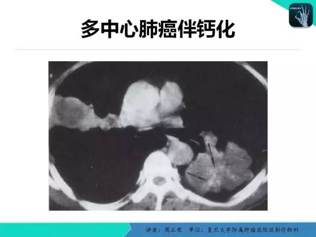 【PPT】肺癌的CT诊断