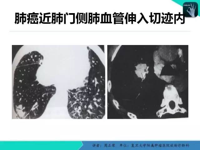 【PPT】肺癌的CT诊断