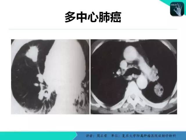 【PPT】肺癌的CT诊断