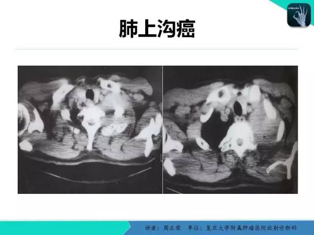【PPT】肺癌的CT诊断