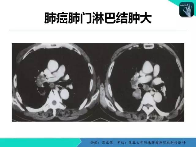 【PPT】肺癌的CT诊断
