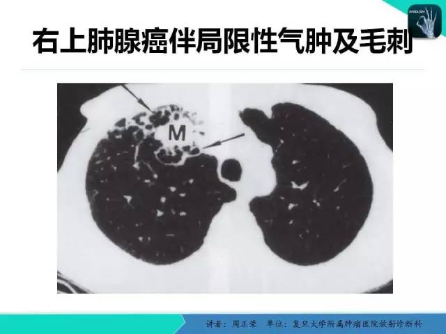 【PPT】肺癌的CT诊断