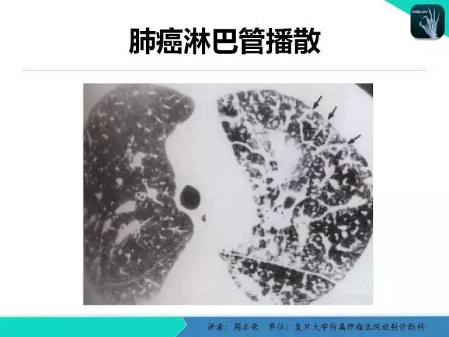 【PPT】肺癌的CT诊断