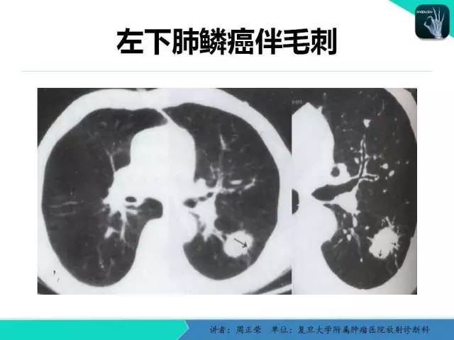【PPT】肺癌的CT诊断