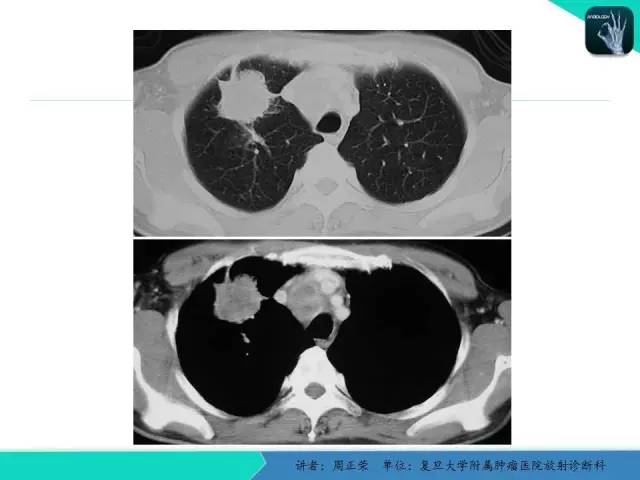 【PPT】肺癌的CT诊断