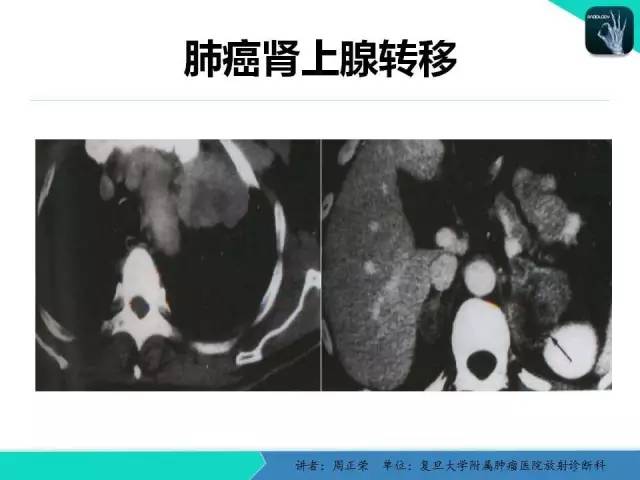 【PPT】肺癌的CT诊断