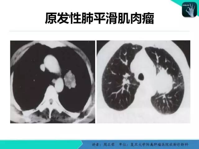 【PPT】肺癌的CT诊断