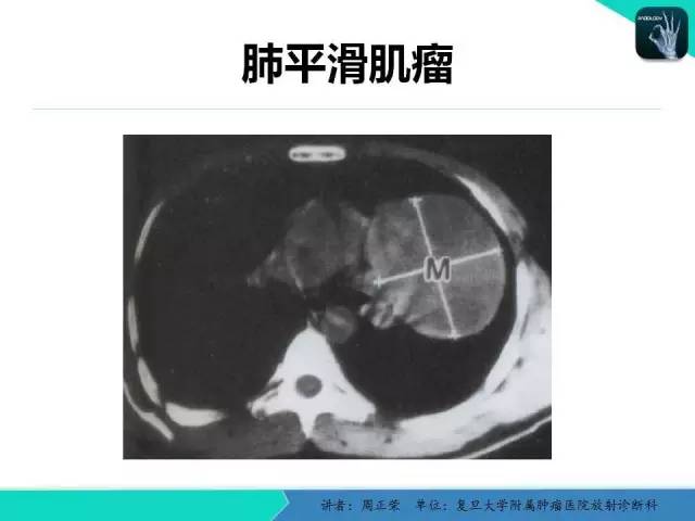 【PPT】肺癌的CT诊断