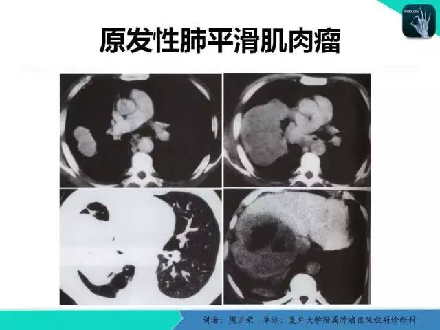 【PPT】肺癌的CT诊断