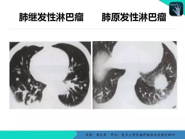 【PPT】肺癌的CT诊断