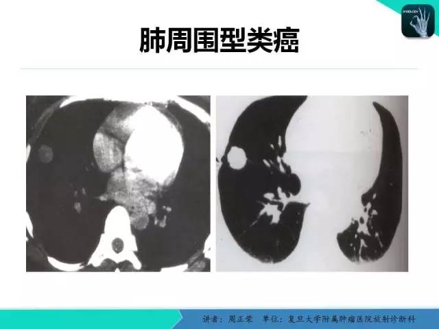 【PPT】肺癌的CT诊断