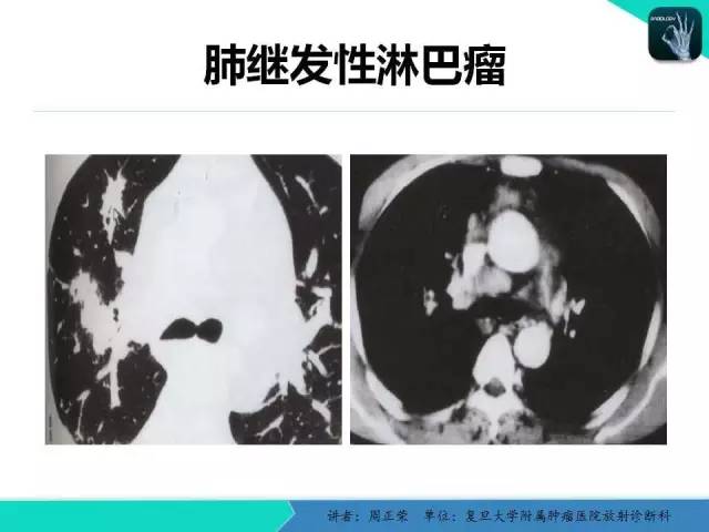 【PPT】肺癌的CT诊断