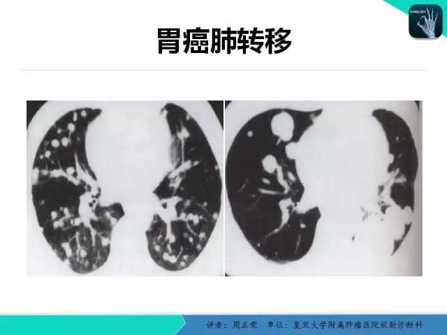 【PPT】肺癌的CT诊断