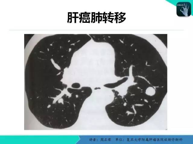 【PPT】肺癌的CT诊断