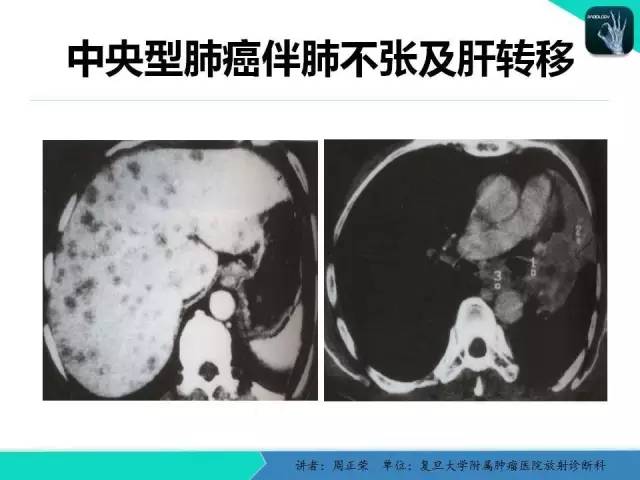 【PPT】肺癌的CT诊断