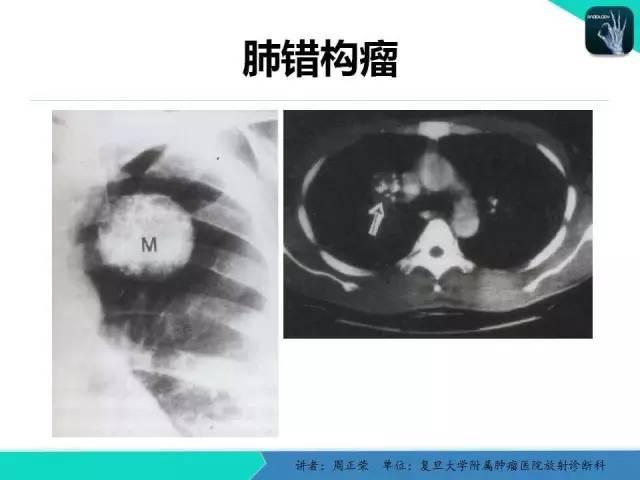 【PPT】肺癌的CT诊断