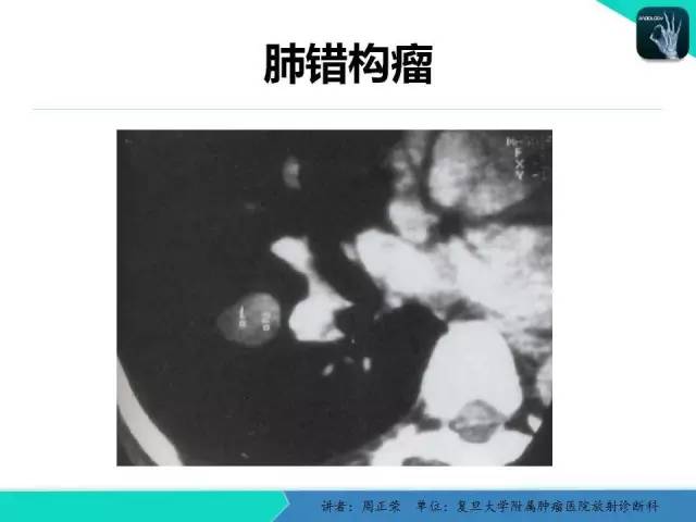 【PPT】肺癌的CT诊断