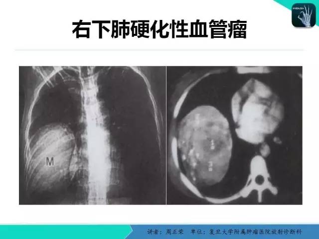 【PPT】肺癌的CT诊断