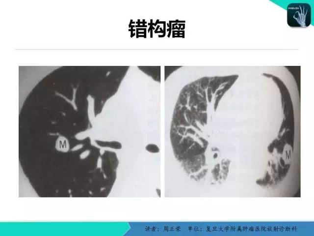 【PPT】肺癌的CT诊断