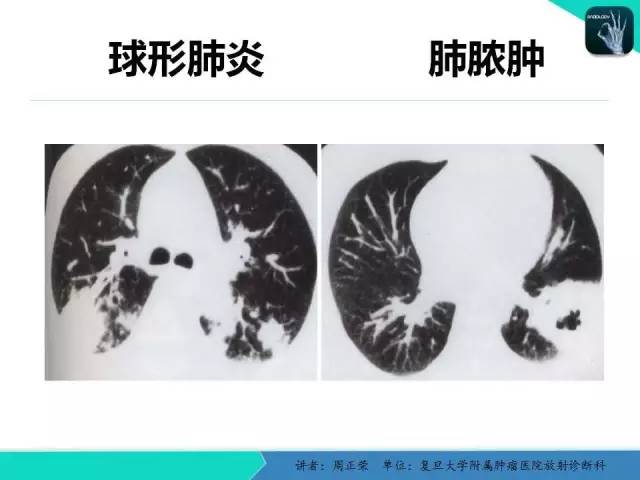 【PPT】肺癌的CT诊断