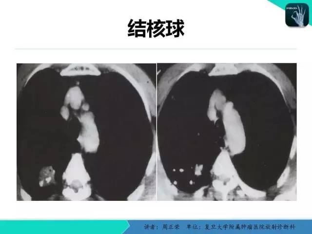 【PPT】肺癌的CT诊断