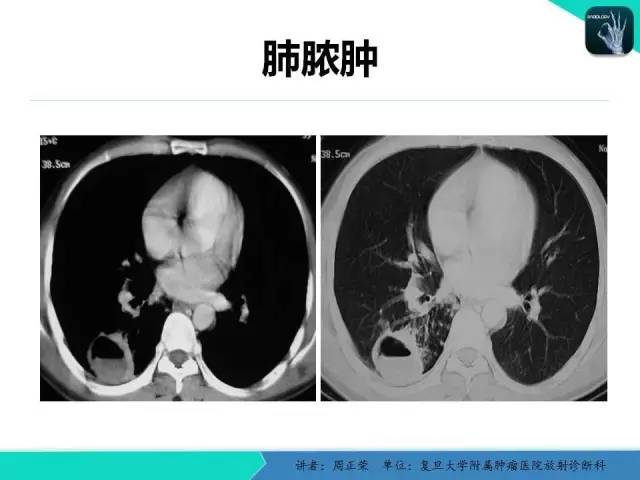 【PPT】肺癌的CT诊断