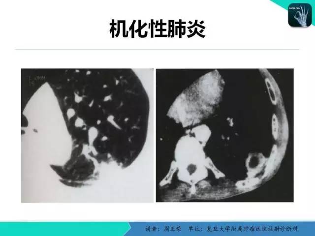 【PPT】肺癌的CT诊断