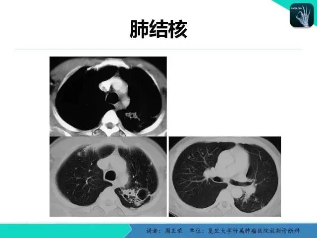 【PPT】肺癌的CT诊断