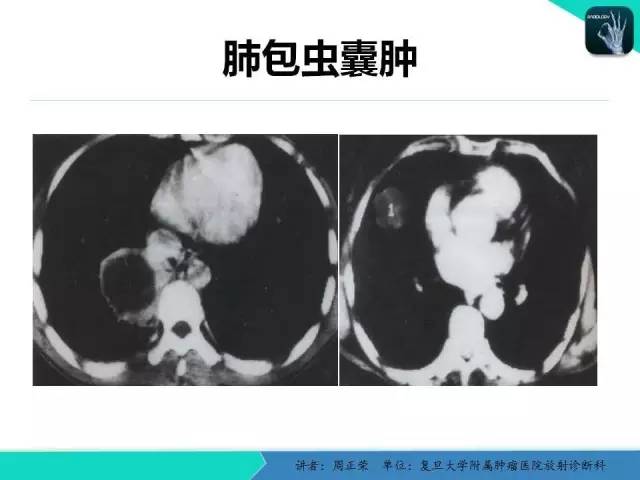 【PPT】肺癌的CT诊断