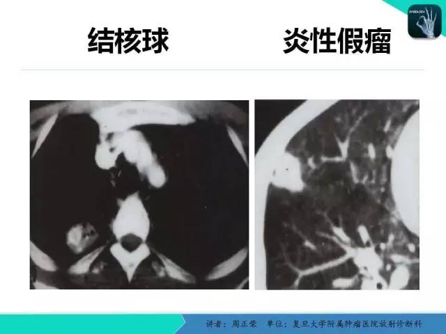 【PPT】肺癌的CT诊断